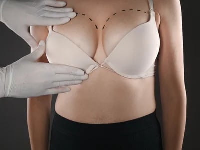 Brustverkleinerung: Fachkompetenz und individuelle Beratung in der Ästhetischen Chirurgie